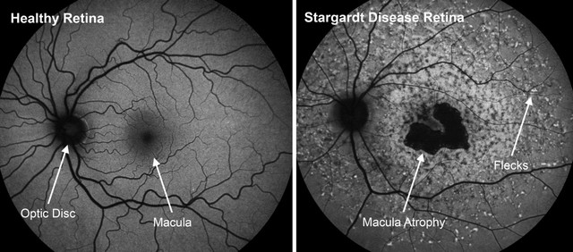 An image showing the retina of Stargardt Disease Credit: Alkeus Pharmaceuticals 