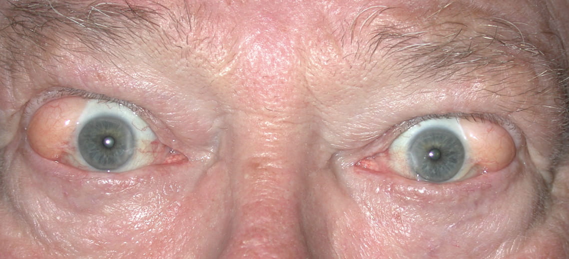 close up picture of a man's eyes with Dermolipoma