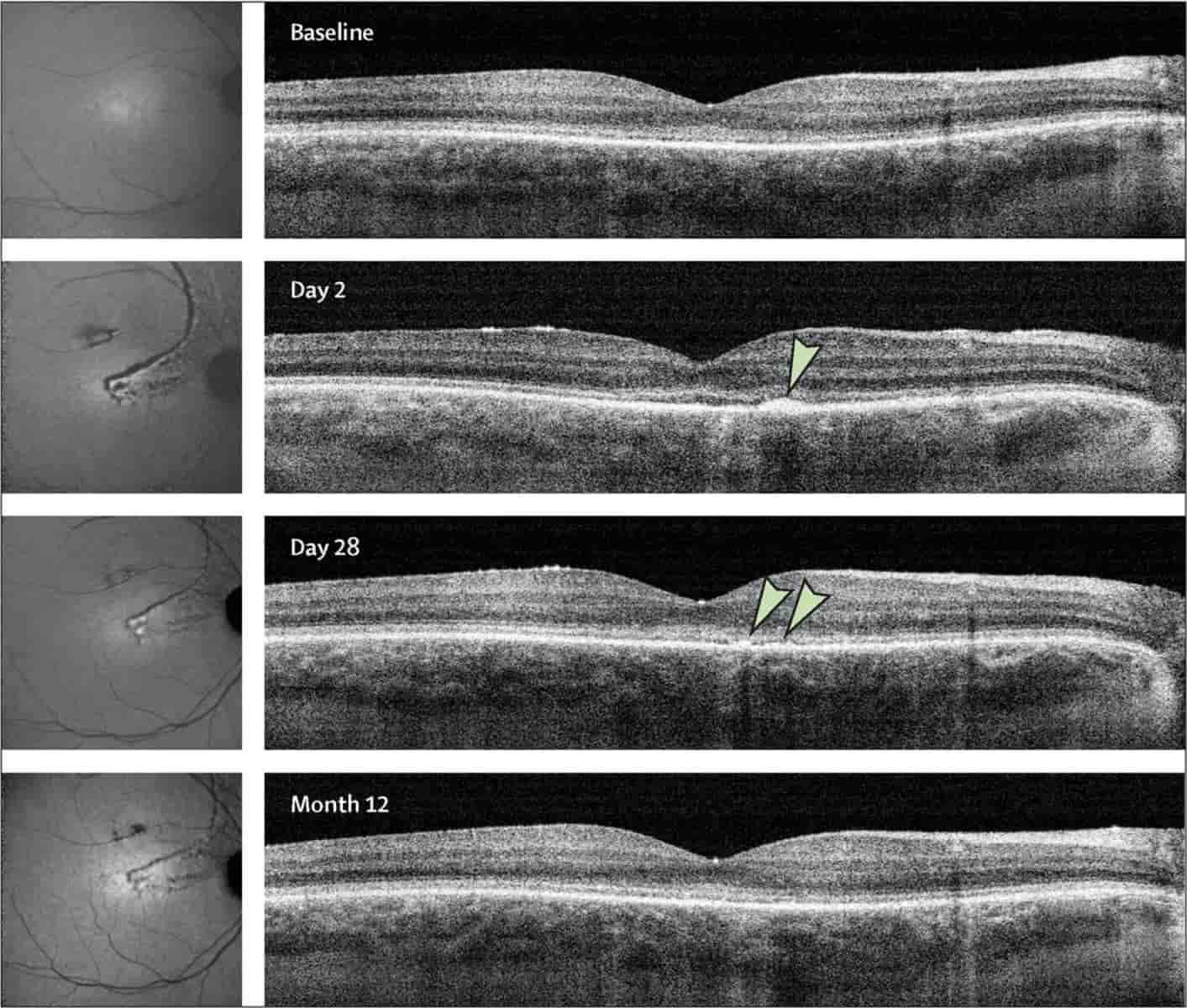 Outer retinal changes in a patient who received the high dose of ATSN-101