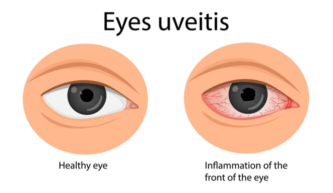 Symptoms of Anteior Uveitis