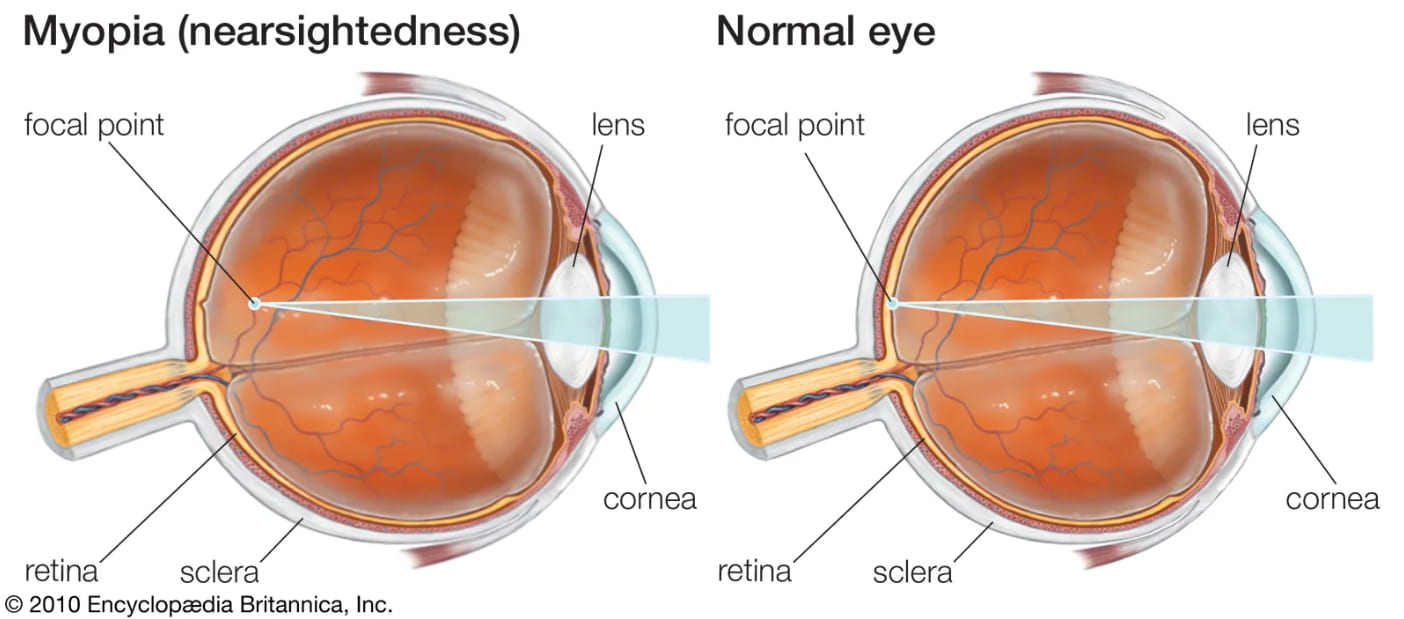 a visual showing the differences between myopia and normal eye