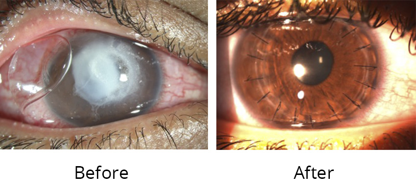 What Is Penetrating Keratoplasty And How To Perform It Obn