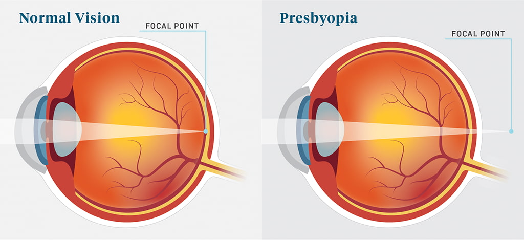 a visual showing the differences between normal vision and presbyopia