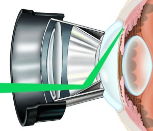 An image showing how Selective laser trabeculoplasty works