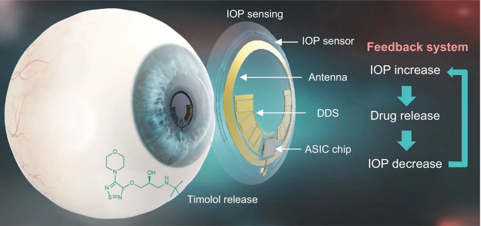 Schematic illustration of a theranostic smart contact lens for glaucoma treatment. Credit: POSTECH