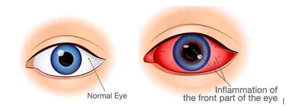Ocular inflammation 